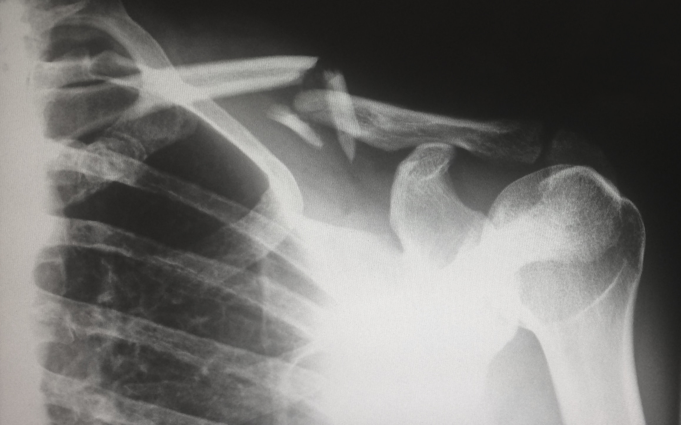 x-ray of broken collar bone